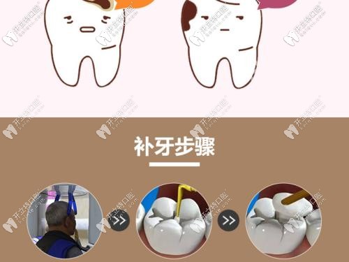 樹脂補牙優(yōu)惠