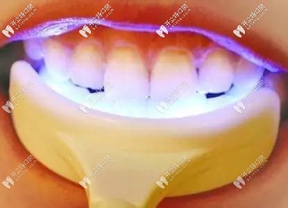 冷光美白不會傷害牙齒