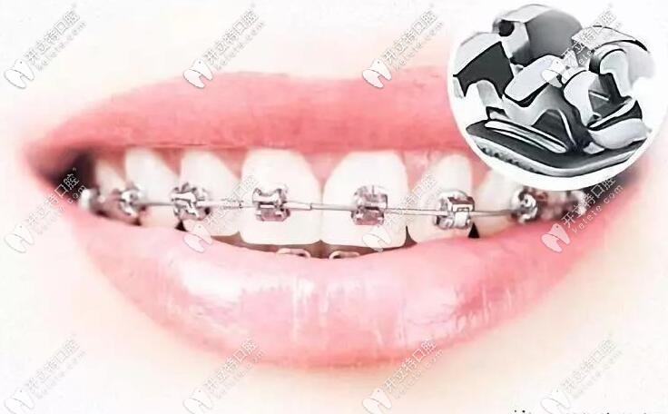 貴陽口腔牙齒矯正價目表:參考自柏德/利美康/德韓正畸價格