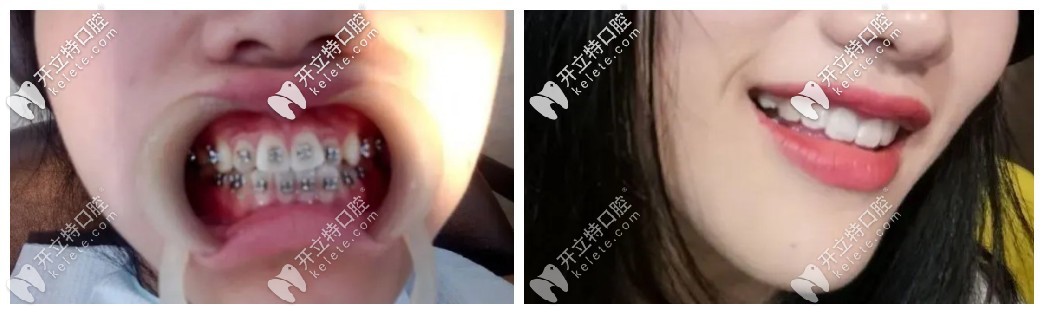 門牙有點(diǎn)外凸可以做國(guó)產(chǎn)普特第五代自鎖托槽來矯正哦