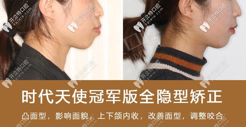  我骨性嘴凸戴時(shí)代天使雙膜牙套矯正后牙齒內(nèi)了收5mm