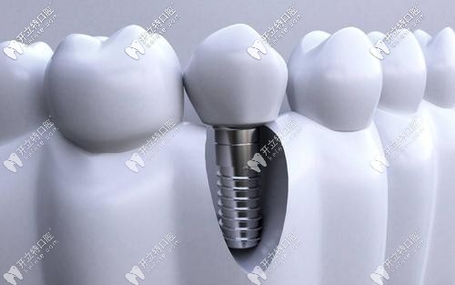 種植牙側(cè)面解析圖