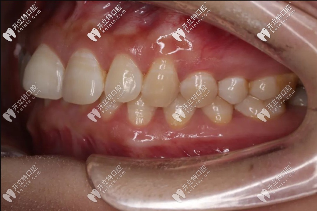 在線看30歲張女士因深覆合做了美國MBT直絲弓矯治