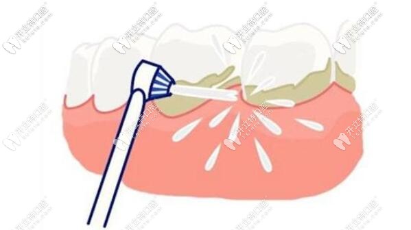 洗牙的好處