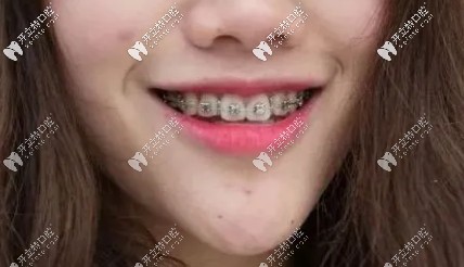 兩年多了，該摘掉牙套啦