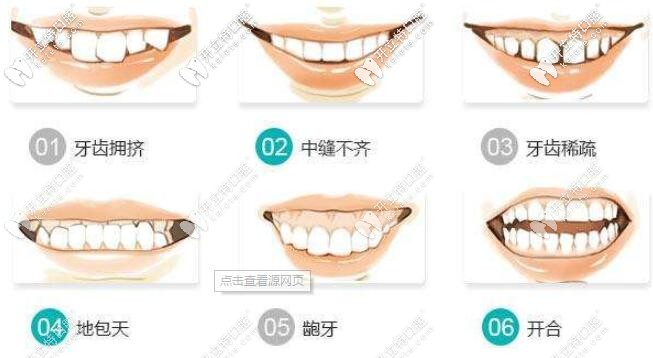 各種牙齒不齊問題都可矯治