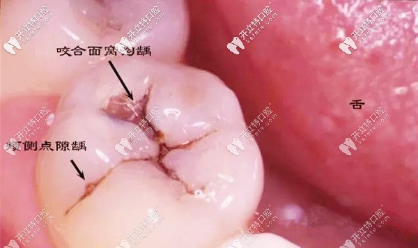 牙齒表面有黑點就是蛀牙哦,此時補(bǔ)牙能省很多錢呢！