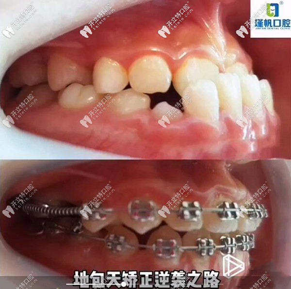 12歲孩子牙齒地包天矯正前后對比照片