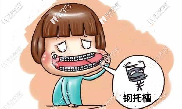 太原市鋼牙套矯正價(jià)格表