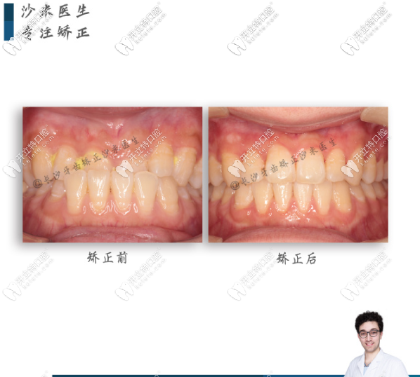 牙祖口腔沙米矯正案例