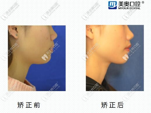 長沙美奧口腔齙牙矯正<span style=