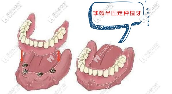 廊坊愛嘉口腔半口球帽半固定種植牙 廊坊愛嘉口腔半口球帽半固定種植牙