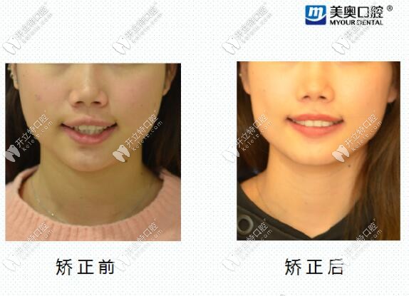 親測長沙美奧口腔醫(yī)院靠譜,看我短下巴金屬矯正1年的效果