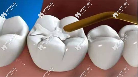 補(bǔ)后槽牙用3M納米樹脂的z350xt還是p60好？