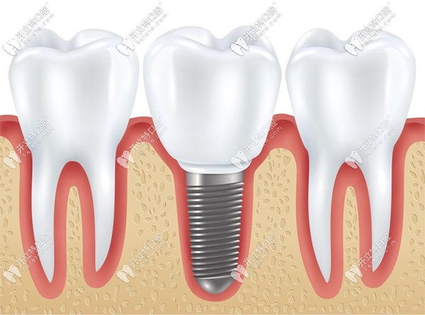 廣州圣貝口腔的孫世堯詳談種植牙修復(fù)過程分幾個(gè)步驟