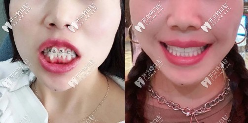 拆除牙套后，喜提一口大白牙