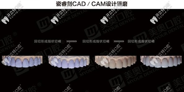 瓷?？藽AD/CAM設(shè)計