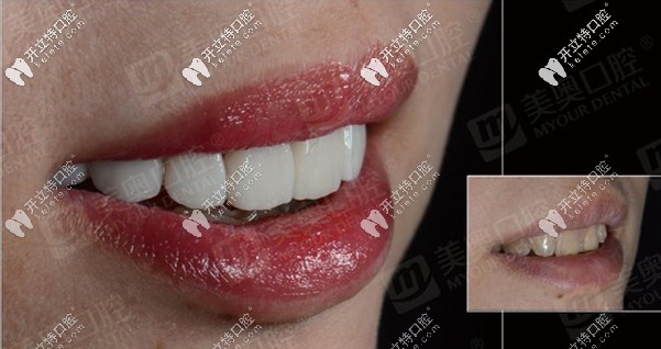 想問：重慶美奧口腔醫(yī)院做義獲嘉全瓷貼面的效果如何？