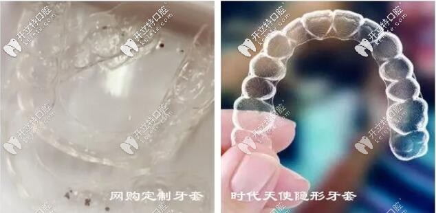 隱形牙套戴了一年沒(méi)效果變化?你不會(huì)是網(wǎng)購(gòu)的牙套吧