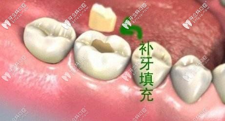3M納米樹脂補(bǔ)牙各型號的區(qū)別及用途