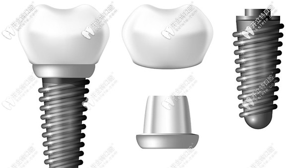 瑞典諾貝爾cc種植牙價(jià)格及使用壽命