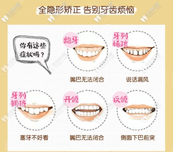 時(shí)代天使隱形矯正適應(yīng)癥