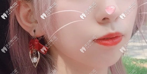 戴了兩年牙套，嘴巴依舊很突