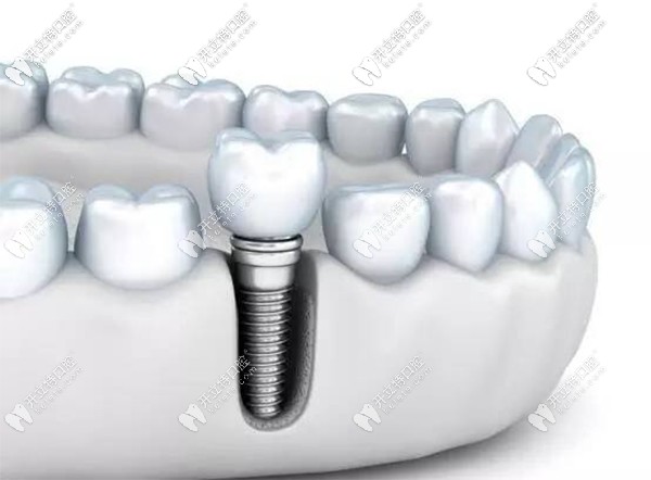 德國瑞西歐種植體