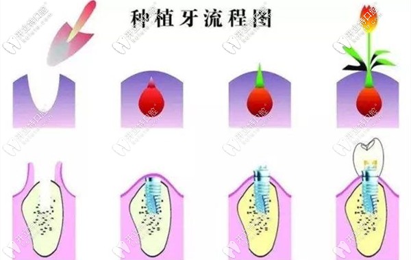 成都武侯區(qū)君臣口腔種植牙費(fèi)用堪比鑲牙