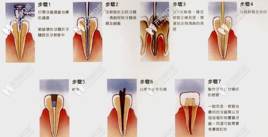 根管治療的全部過程