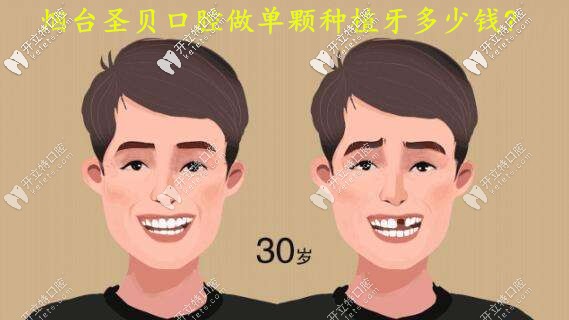 看芝罘區(qū)圣貝牙科單顆種植牙的價(jià)格及顯微鏡種植技術(shù)