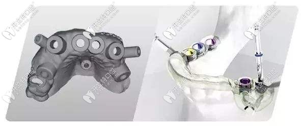 通過CAD/CAM激光掃描和CBCT實現(xiàn)導板種植 通過CAD/CAM激光掃描和CBCT實現(xiàn)導板種植