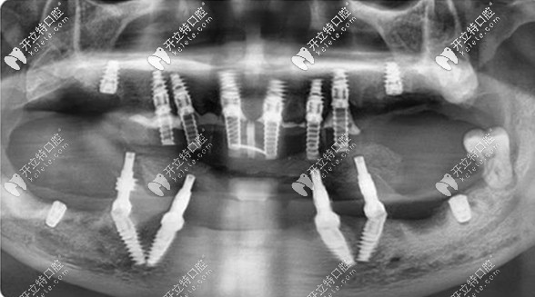 all-on-4/6全口即拔即種的線片圖