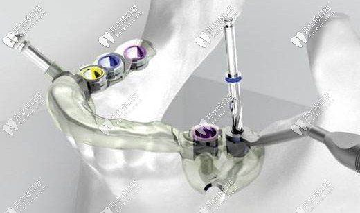 3D數(shù)字化導板種植技術(shù) 3D數(shù)字化導板種植技術(shù)