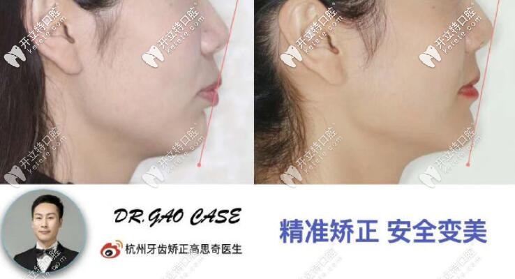 剛整理的杭州美奧口腔凸嘴齙牙矯正案例及收費(fèi)價格