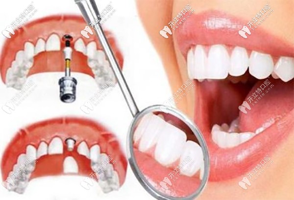 看看登騰與奧齒泰優(yōu)劣對比