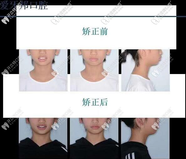 反頜牙齒擁擠,14歲兒童的拔牙之國產(chǎn)金屬自鎖托槽矯正之旅