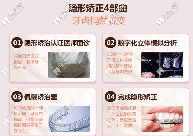 無托槽隱形矯正器的優(yōu)勢(shì)