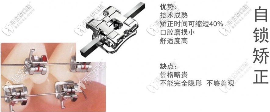 金屬自鎖矯正的特點(diǎn)