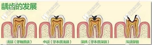 齲病的發(fā)展 齲病的發(fā)展