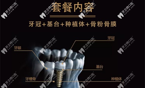 瑞典諾貝爾pmc套餐價內容