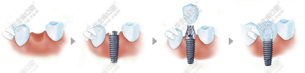 種植牙的過(guò)程示意圖