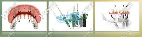 北京做allon4速導(dǎo)半口種植牙的費(fèi)用