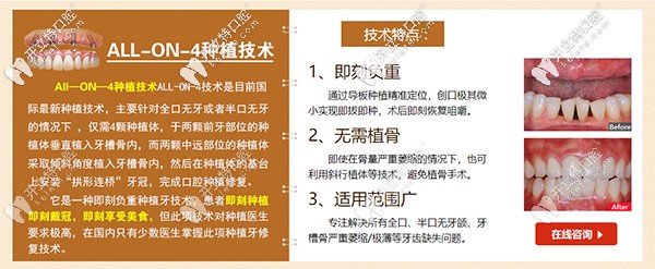 All-on-4速導(dǎo)半口種植牙特點(diǎn)