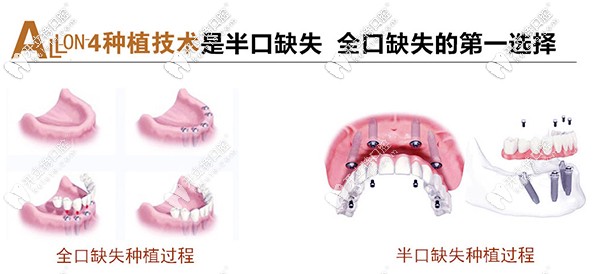 北京市朝陽區(qū)維樂做allon4速導(dǎo)半口種植牙價格是多少？
