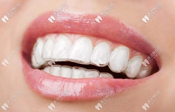 活動(dòng)期間訂購(gòu)正雅隱形矯正可免方案和取模費(fèi) 活動(dòng)期間訂購(gòu)正雅隱形矯正可免方案和取模費(fèi)