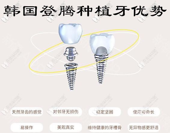 <!--<i data=20240703-sp></i>-->口腔韓國登騰種植牙優(yōu)勢
