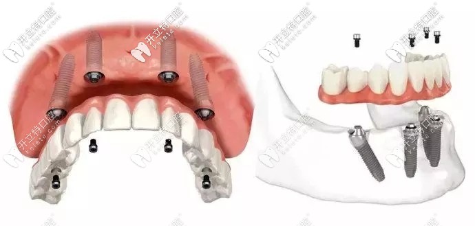 allon4半口種植牙