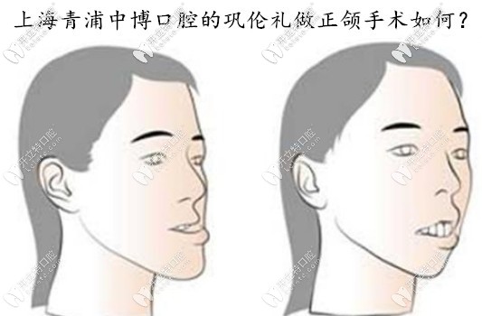 誰(shuí)知道上海中博口腔做地包天正頜手術(shù)的醫(yī)生是誰(shuí)？