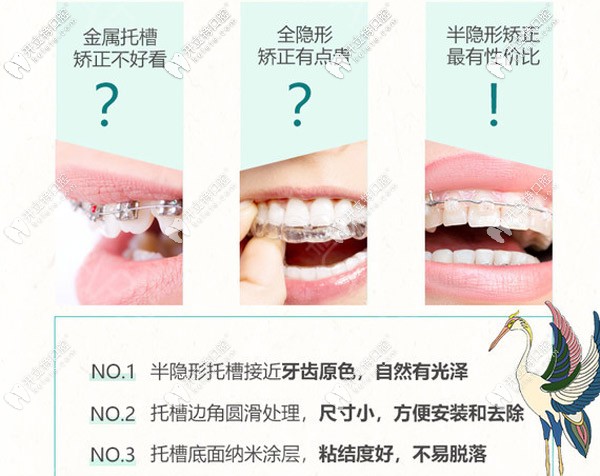 半隱形矯正咋樣 半隱形矯正咋樣